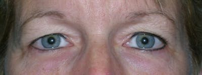 Blepharoplasty Before & After Gallery - Patient 23532758 - Image 1