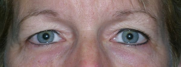 Blepharoplasty Before & After Gallery - Patient 23532758 - Image 1