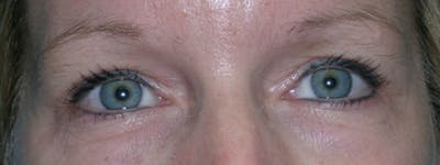 Blepharoplasty Before & After Gallery - Patient 23532758 - Image 2