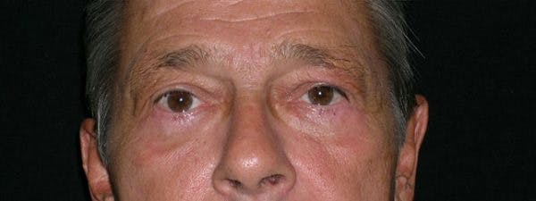 Blepharoplasty Before & After Gallery - Patient 23532759 - Image 2