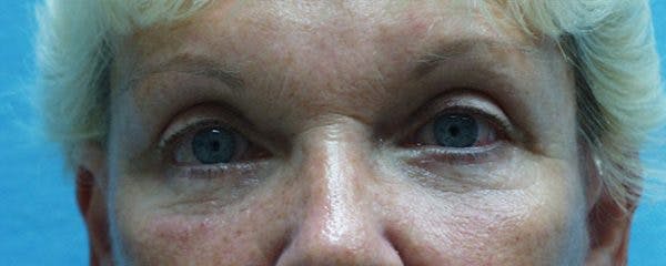 Blepharoplasty Before & After Gallery - Patient 23532768 - Image 2