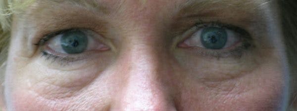 Blepharoplasty Before & After Gallery - Patient 23532771 - Image 1