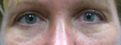 Blepharoplasty Before & After Gallery - Patient 23532771 - Image 2