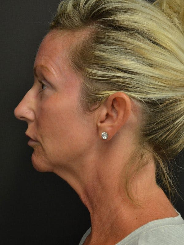 Facelift Before & After Gallery - Patient 23532948 - Image 1
