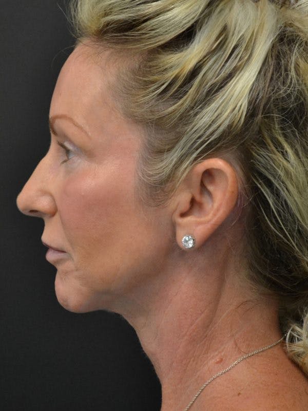 Facelift Before & After Gallery - Patient 23532948 - Image 2