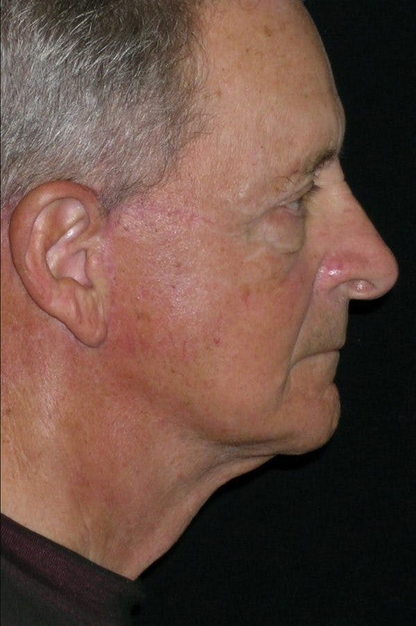Facelift Before & After Gallery - Patient 23532949 - Image 2