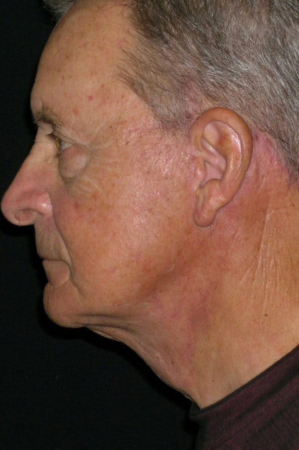 Facelift Before & After Gallery - Patient 23532949 - Image 4