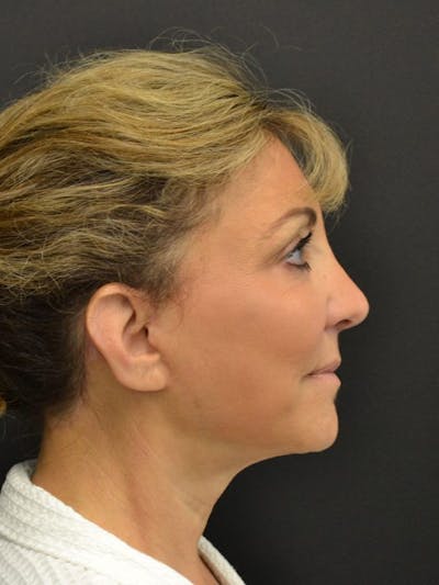 Facelift Before & After Gallery - Patient 23532951 - Image 4