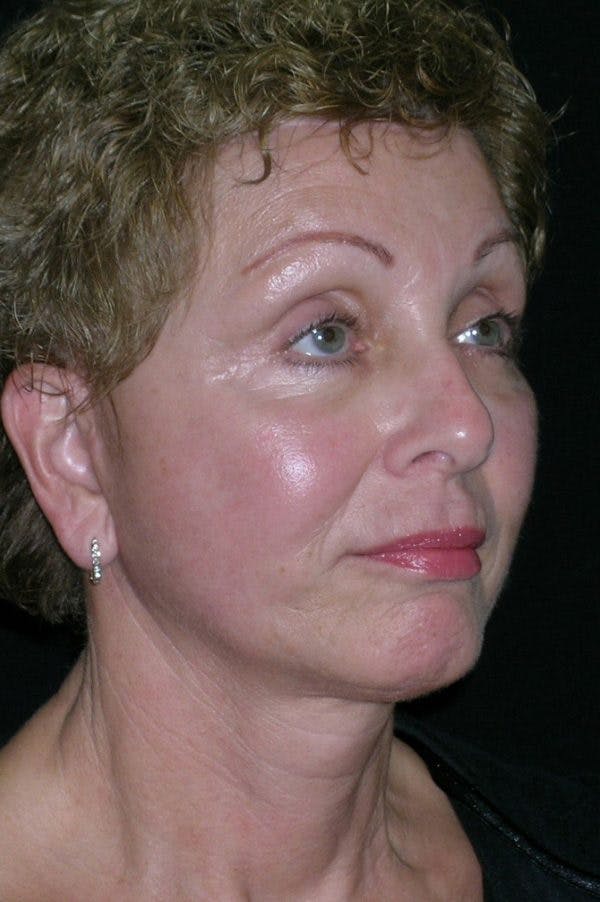 Facelift Before & After Gallery - Patient 23532952 - Image 2