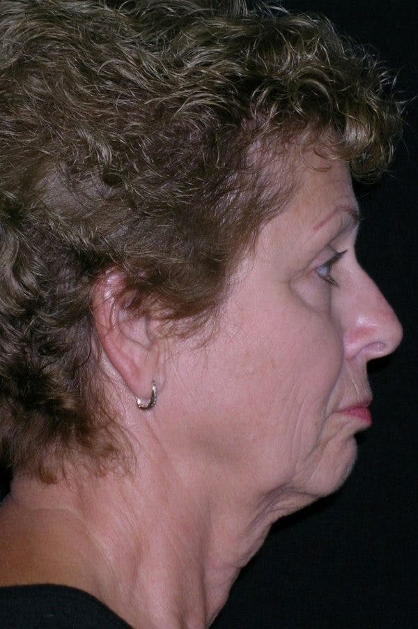 Facelift Before & After Gallery - Patient 23532952 - Image 3