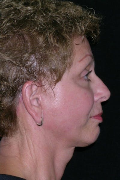Facelift Before & After Gallery - Patient 23532952 - Image 4