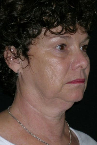 Facelift Before & After Gallery - Patient 23532953 - Image 1