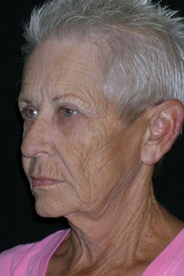 Facelift Before & After Gallery - Patient 23532954 - Image 1