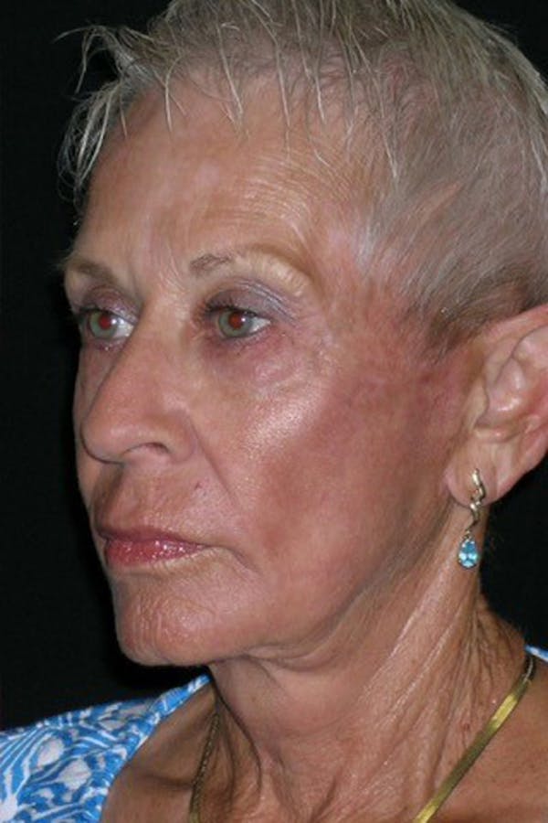 Facelift Before & After Gallery - Patient 23532954 - Image 2