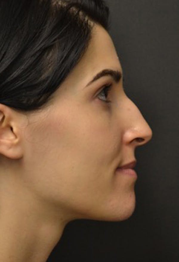 Rhinoplasty Before & After Gallery - Patient 23533023 - Image 1