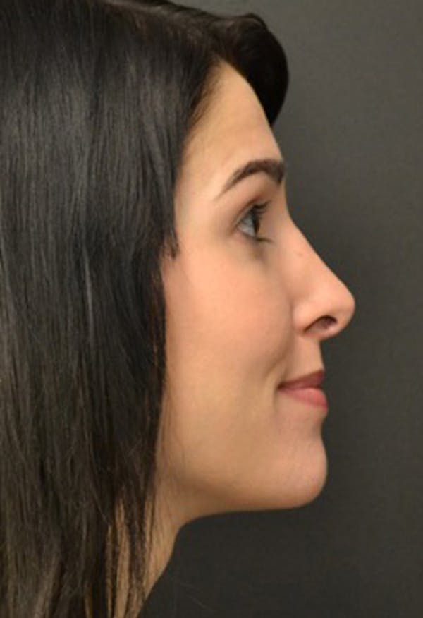 Rhinoplasty Before & After Gallery - Patient 23533023 - Image 2