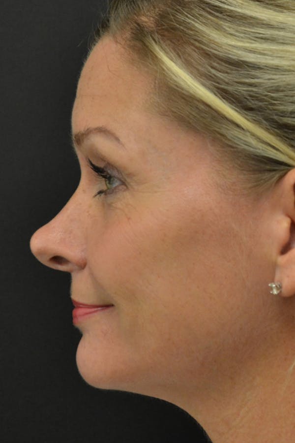 Rhinoplasty Before & After Gallery - Patient 23533027 - Image 3