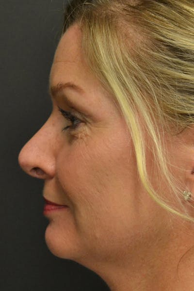 Rhinoplasty Before & After Gallery - Patient 23533027 - Image 4