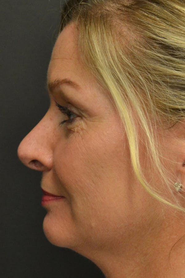 Rhinoplasty Before & After Gallery - Patient 23533027 - Image 4