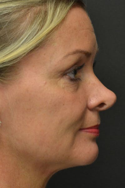 Rhinoplasty Before & After Gallery - Patient 23533027 - Image 1