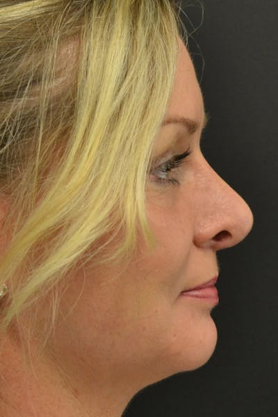 Rhinoplasty Before & After Gallery - Patient 23533027 - Image 2