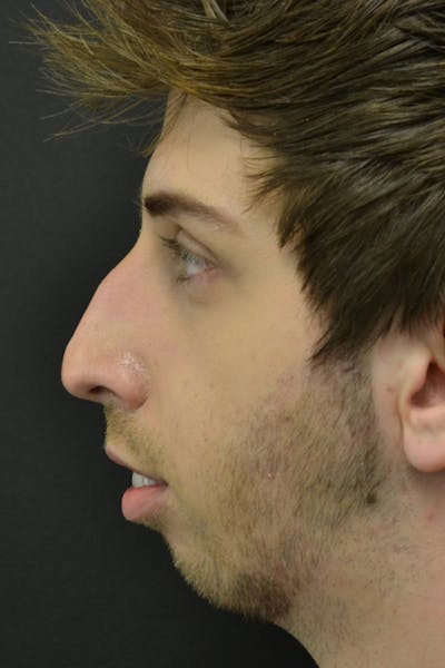 Rhinoplasty Before & After Gallery - Patient 23533030 - Image 1