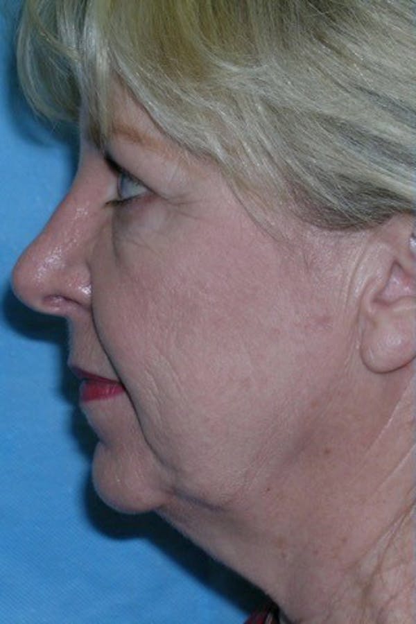 Neck Lift Before & After Gallery - Patient 23533045 - Image 1