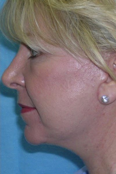 Neck Lift Before & After Gallery - Patient 23533045 - Image 2