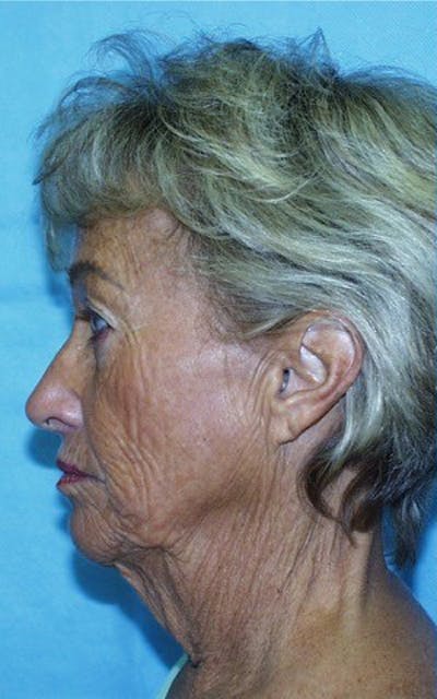 Neck Lift Before & After Gallery - Patient 23533047 - Image 1