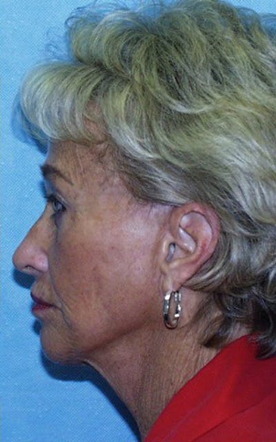 Neck Lift Before & After Gallery - Patient 23533047 - Image 2