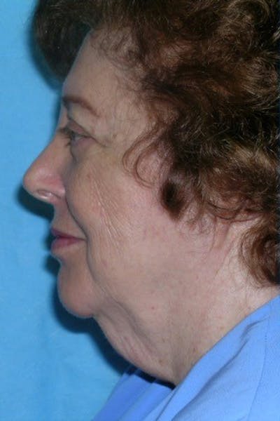 Neck Lift Before & After Gallery - Patient 23533067 - Image 1