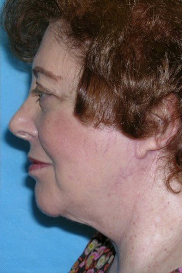 Neck Lift Before & After Gallery - Patient 23533067 - Image 2