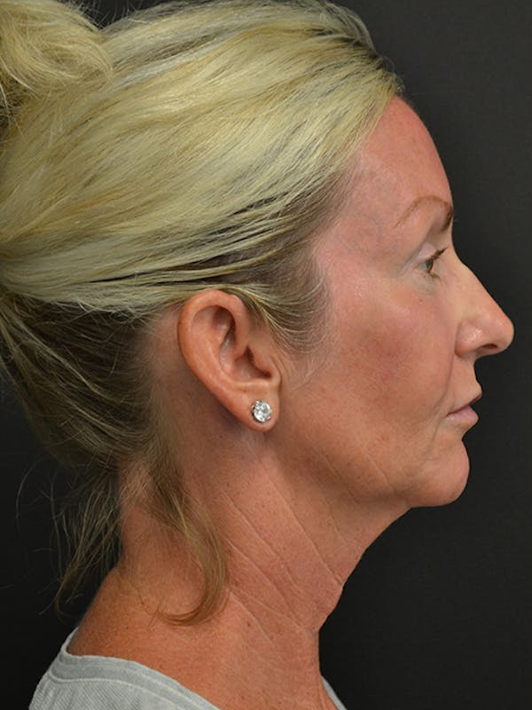 Neck Lift Before & After Gallery - Patient 23533072 - Image 3