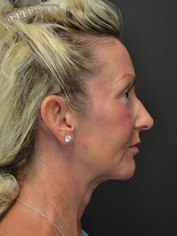 Neck Lift Before & After Gallery - Patient 23533072 - Image 4