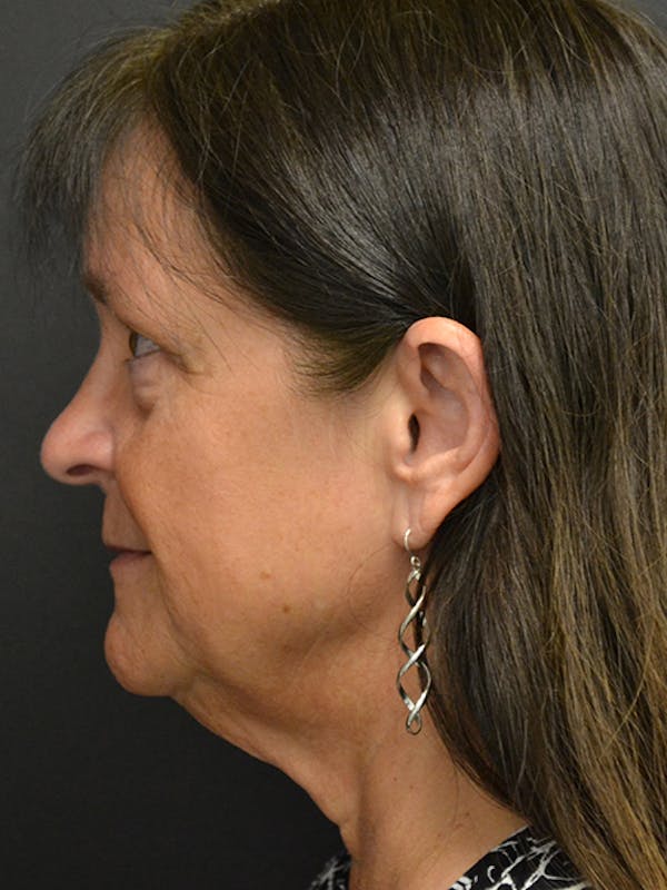 Neck Lift Before & After Gallery - Patient 23533075 - Image 1