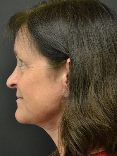 Neck Lift Before & After Gallery - Patient 23533075 - Image 2