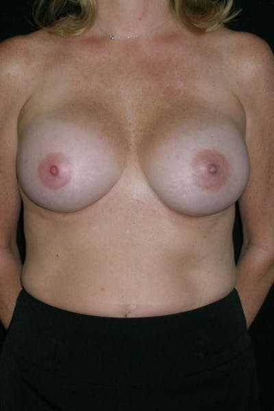 Breast Augmentation Before & After Gallery - Patient 23533098 - Image 2