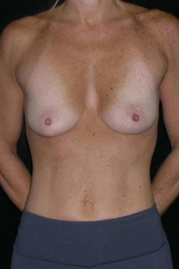Breast Augmentation Before & After Gallery - Patient 23533100 - Image 1