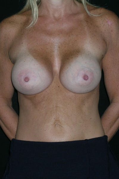 Breast Augmentation Before & After Gallery - Patient 23533100 - Image 2