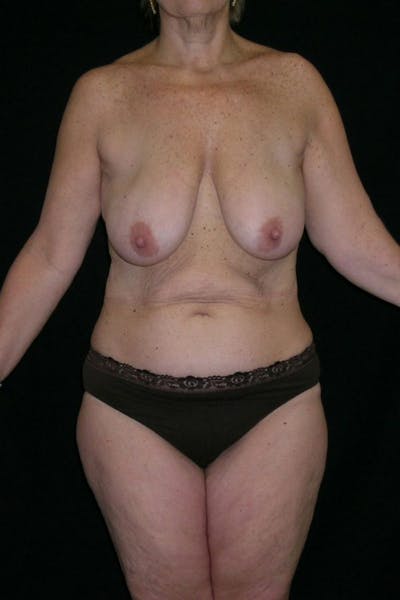 Breast Augmentation Before & After Gallery - Patient 23533101 - Image 1