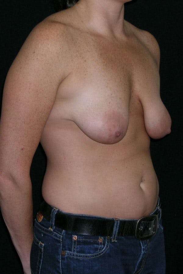 Breast Augmentation Before & After Gallery - Patient 23533104 - Image 5