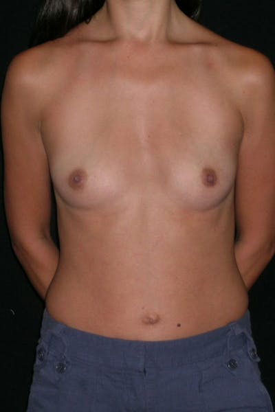 Breast Augmentation Before & After Gallery - Patient 23533128 - Image 1