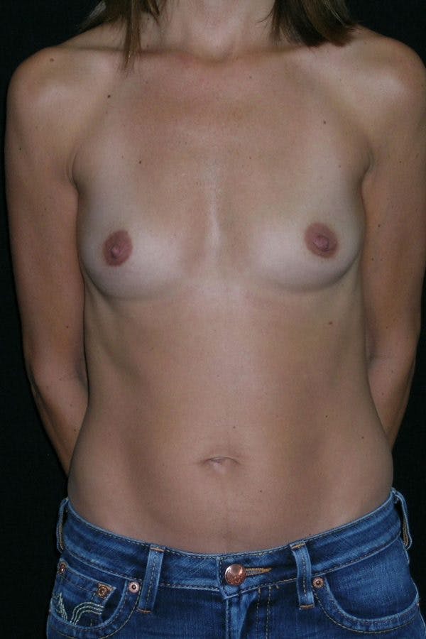 Breast Augmentation Before & After Gallery - Patient 23533130 - Image 1