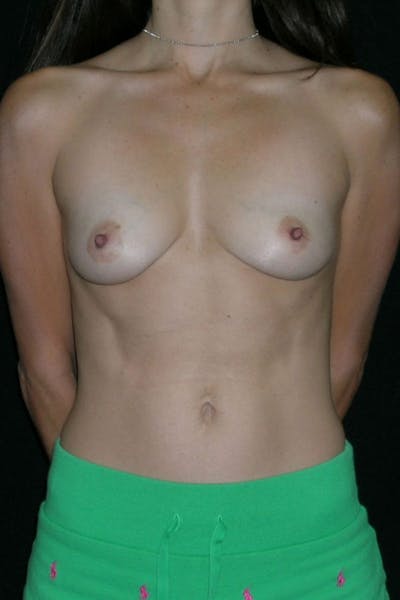 Breast Augmentation Before & After Gallery - Patient 23533140 - Image 1
