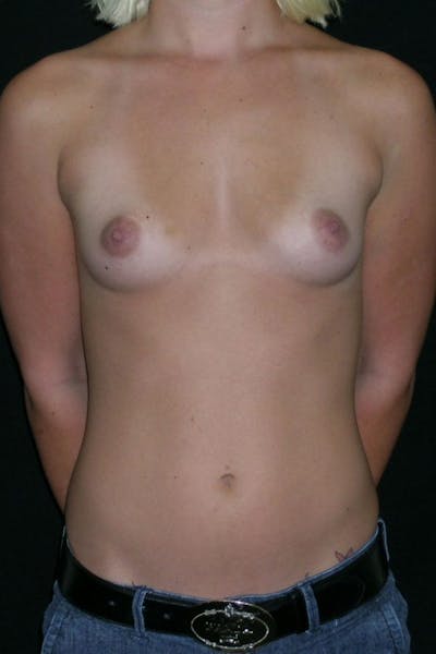 Breast Augmentation Before & After Gallery - Patient 23533147 - Image 1