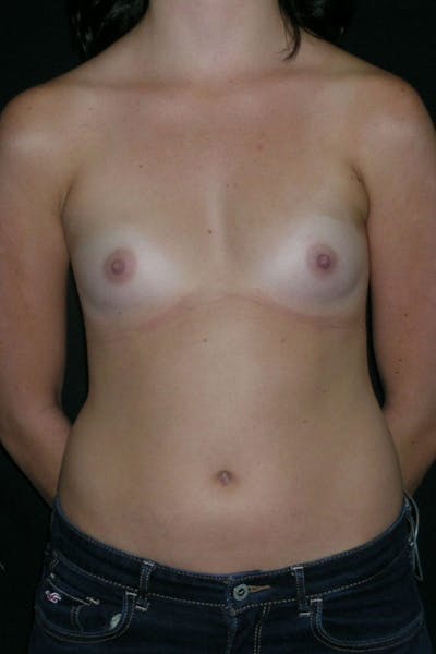 Breast Augmentation Before & After Gallery - Patient 23533148 - Image 1