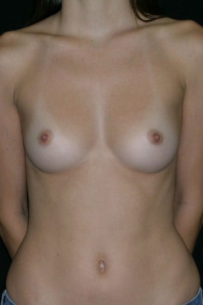 Breast Augmentation Before & After Gallery - Patient 23533155 - Image 1