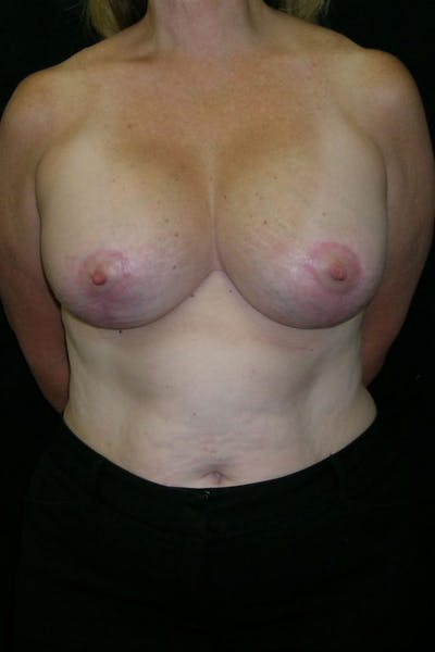 Breast Augmentation Before & After Gallery - Patient 23533166 - Image 2