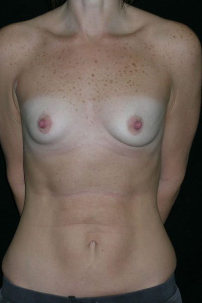 Breast Augmentation Before & After Gallery - Patient 23533181 - Image 1