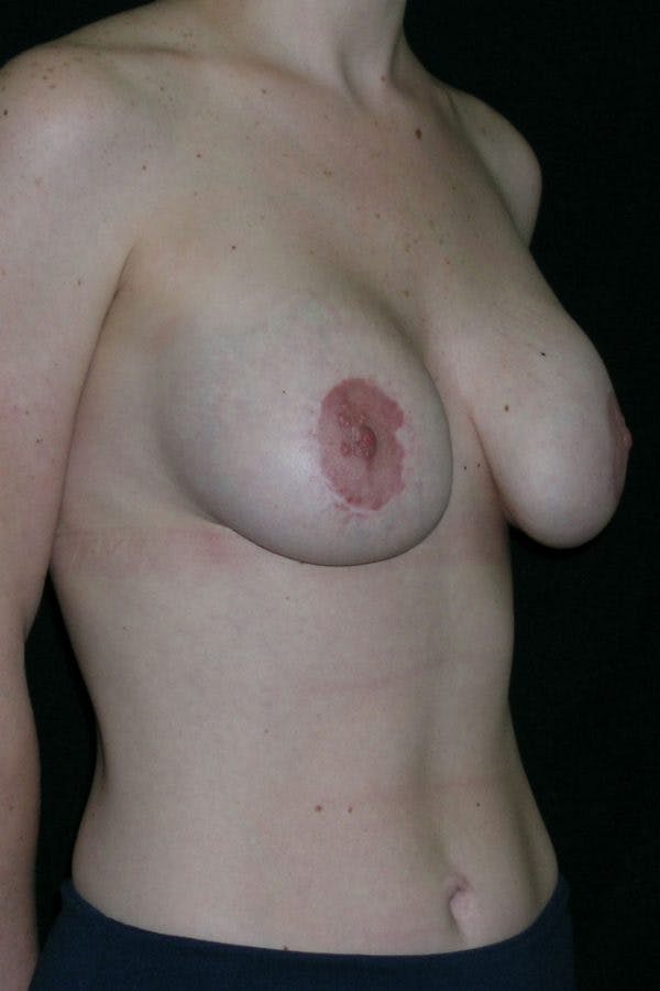 Breast Augmentation Before & After Gallery - Patient 23533190 - Image 3